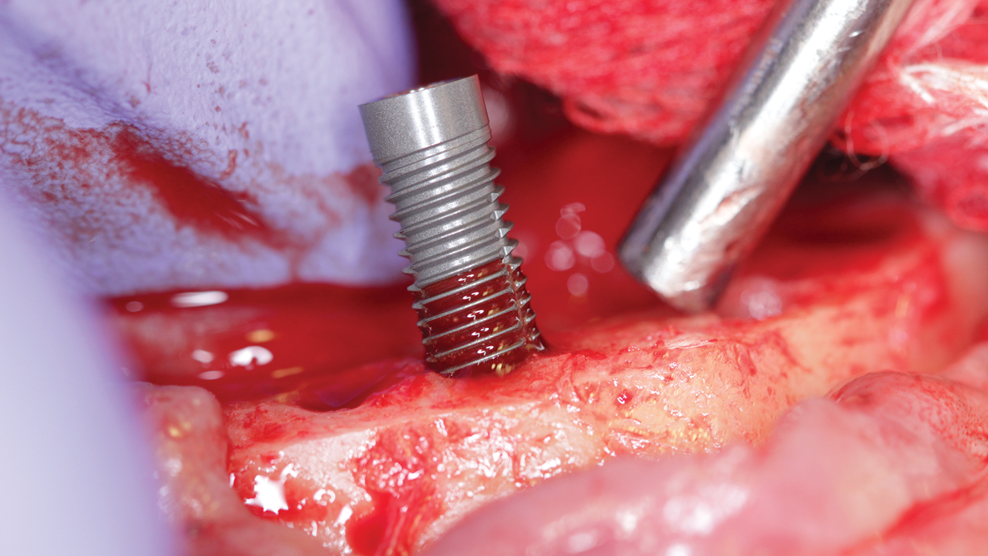 Figure 1: Implant being placed for a fixed hybrid