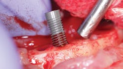 Figure 1: Implant being placed for a fixed hybrid Figure 1: Implant being placed for a fixed hybrid