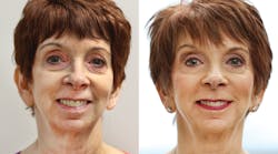 This rejuvenation with Botox, fillers, and lifting PDO threads before implants and veneers on this 75-year-old patient is remarkable.