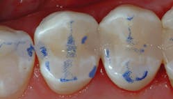 Figure 3: The rubber dam has just been taken off these teeth, so the color will not match for a few minutes. It is obvious that the occlusion is mostly on tooth structure&mdash;not restorative material. Such small and narrow preps restored with the current generation of excellent resin-based composites will serve for twice as long as larger restorations.