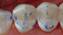 Figure 3: The rubber dam has just been taken off these teeth, so the color will not match for a few minutes. It is obvious that the occlusion is mostly on tooth structure—not restorative material. Such small and narrow preps restored with the current generation of excellent resin-based composites will serve for twice as long as larger restorations. Figure 3: The rubber dam has just been taken off these teeth, so the color will not match for a few minutes. It is obvious that the occlusion is mostly on tooth structure—not restorative material. Such small and narrow preps restored with the current generation of excellent resin-based composites will serve for twice as long as larger restorations.