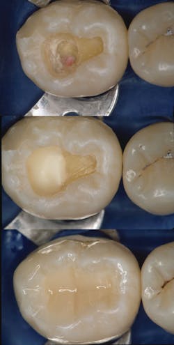 Figure 4: Direct or indirect pulp caps as follows: avoid exposing if possible, place glutaraldehyde—Gluma (Kulzer), MicroPrime G (Zest), or others—for two one-minute applications. Then, suction off the glutaraldehyde, place one of the pulp caps indicated in this article, etch, bond, and place resin. Do not do endo unless proven to be absolutely necessary. Save the vitality of the tooth. Figure 4: Direct or indirect pulp caps as follows: avoid exposing if possible, place glutaraldehyde—Gluma (Kulzer), MicroPrime G (Zest), or others—for two one-minute applications. Then, suction off the glutaraldehyde, place one of the pulp caps indicated in this article, etch, bond, and place resin. Do not do endo unless proven to be absolutely necessary. Save the vitality of the tooth.