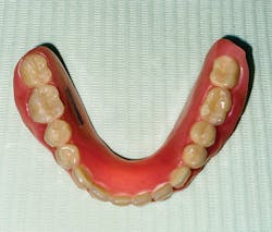 Figure 2: Traditional full lower denture Figure 2: Traditional full lower denture