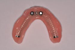 Figure 3: Traditional implant-supported overdenture&mdash;aka &apos;snap-on&apos; denture
