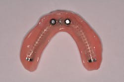Figure 3: Traditional implant-supported overdenture—aka 'snap-on' denture Figure 3: Traditional implant-supported overdenture—aka 'snap-on' denture