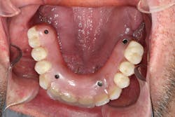 Figure 4: Definitive All-on-4 that had been in service for three years Figure 4: Definitive All-on-4 that had been in service for three years