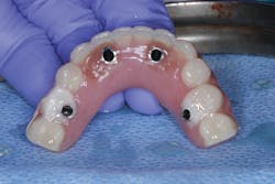 Figure 5: Interim All-on-4 Figure 5: Interim All-on-4