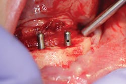 Figure 6: Implants being placed for a fixed hybrid Figure 6: Implants being placed for a fixed hybrid