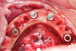 Figure 7: Implants being placed for a fixed hybrid Figure 7: Implants being placed for a fixed hybrid