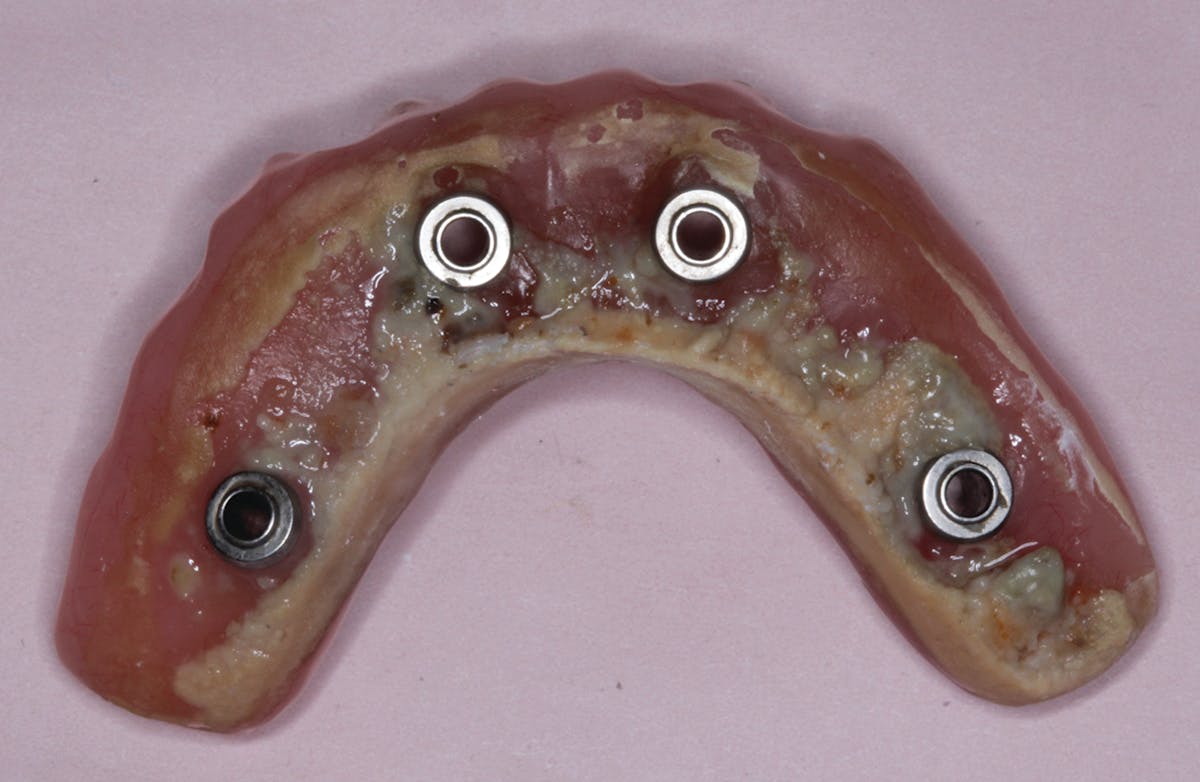 Figure 8: Definitive All-on-4 removed after one year