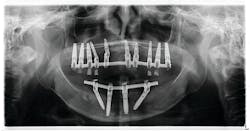 Figure 9: Double-arch fixed hybrid, 10-on-4 Figure 9: Double-arch fixed hybrid, 10-on-4