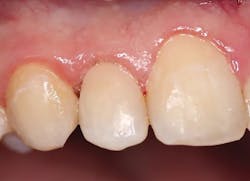 Figures 1 and 2: Class V restoration on tooth no. 7 completed with Omnichroma and illustrating its chameleon effect Figures 1 and 2: Class V restoration on tooth no. 7 completed with Omnichroma and illustrating its chameleon effect