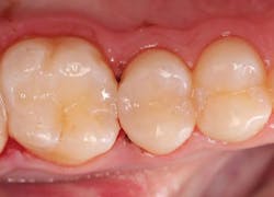 Figures 3 and 4: Class II composite using Omnichroma Figures 3 and 4: Class II composite using Omnichroma