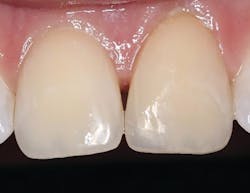 Figures 5 and 6: Fractured class IV on tooth no. 9 restored using Omnichroma