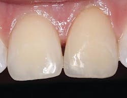 Figures 5 and 6: Fractured class IV on tooth no. 9 restored using Omnichroma Figures 5 and 6: Fractured class IV on tooth no. 9 restored using Omnichroma