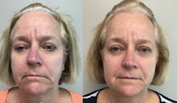 A mature patient before and after treatment with Botox, fillers, and lifting PDO threads. She is now ready for porcelain veneers with better soft tissue support.