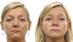 Midface volume loss makes this patient appear much older than she is. Fillers replace volume in her midface.