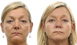 Midface volume loss makes this patient appear much older than she is. Fillers replace volume in her midface. Midface volume loss makes this patient appear much older than she is. Fillers replace volume in her midface.