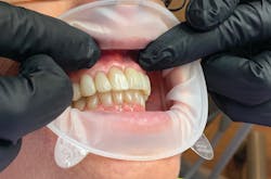 Figure 1: Before proceeding with treatment, place OptraGate (Ivoclar Vivadent), a latex-free retraction device for visibility and protection of lips. Figure 1: Before proceeding with treatment, place OptraGate (Ivoclar Vivadent), a latex-free retraction device for visibility and protection of lips.