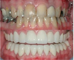 Figure 5: A disaster patient who had multiple restorations and eventually two separate rehabs before age 35. It is obvious that the conservative characteristics described in this article were not done. Figure 5: A disaster patient who had multiple restorations and eventually two separate rehabs before age 35. It is obvious that the conservative characteristics described in this article were not done.