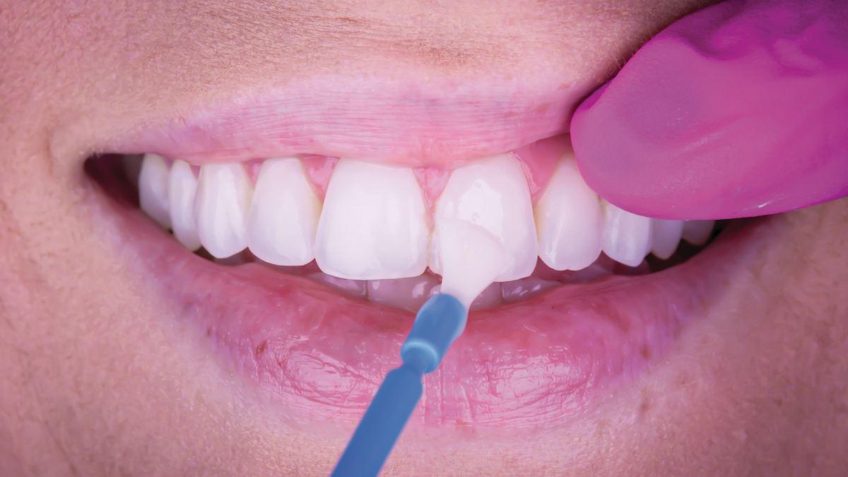 Fluoride varnishes: What is the difference, and which one is best? | Dental  Economics