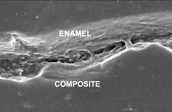 Figure 1: Scanning electron microscope photos of the margins of a typical composite resin restoration show wide-open margins at 1,000X. This shrinkage cannot be avoided with composite or to a lesser degree with resin-modified glass ionomer. (Courtesy of TRAC Research Division of Clinicians Report Foundation.) Figure 1: Scanning electron microscope photos of the margins of a typical composite resin restoration show wide-open margins at 1,000X. This shrinkage cannot be avoided with composite or to a lesser degree with resin-modified glass ionomer. (Courtesy of TRAC Research Division of Clinicians Report Foundation.)