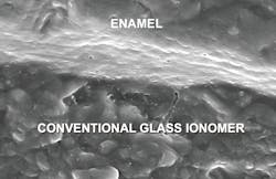 Figure 2: This in vivo image shows one of the new conventional glass ionomer restorations with the nonshrinking glass ionomer margins closed. Examples of proven products are Equia Forte (GC America), Ketac Universal (3M), and others. Margin closure has now been observed using electron microscopy for two years with the expectation that this will continue. (Courtesy TRAC Research Division of Clinicians Report Foundation.)
