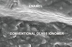Figure 2: This in vivo image shows one of the new conventional glass ionomer restorations with the nonshrinking glass ionomer margins closed. Examples of proven products are Equia Forte (GC America), Ketac Universal (3M), and others. Margin closure has now been observed using electron microscopy for two years with the expectation that this will continue. (Courtesy TRAC Research Division of Clinicians Report Foundation.) Figure 2: This in vivo image shows one of the new conventional glass ionomer restorations with the nonshrinking glass ionomer margins closed. Examples of proven products are Equia Forte (GC America), Ketac Universal (3M), and others. Margin closure has now been observed using electron microscopy for two years with the expectation that this will continue. (Courtesy TRAC Research Division of Clinicians Report Foundation.)