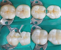 Figure 3: A typical example showing minimal class II tooth preparations, well-controlled glutaraldehyde placement with a microbrush, and the finished composite restorations