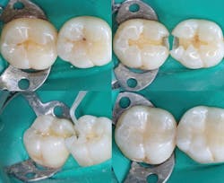 Figure 3: A typical example showing minimal class II tooth preparations, well-controlled glutaraldehyde placement with a microbrush, and the finished composite restorations Figure 3: A typical example showing minimal class II tooth preparations, well-controlled glutaraldehyde placement with a microbrush, and the finished composite restorations
