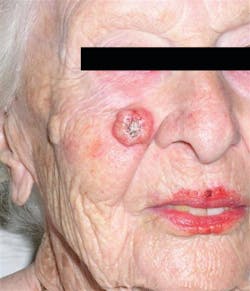 Figure 1: Squamous cell carcinoma Figure 1: Squamous cell carcinoma