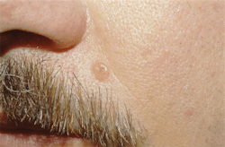 Figure 2: Basal cell carcinoma Figure 2: Basal cell carcinoma