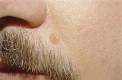 Figure 2: Basal cell carcinoma Figure 2: Basal cell carcinoma
