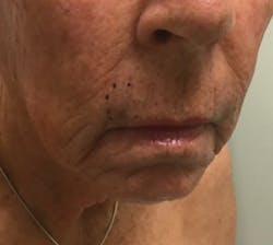 Figure 3: Melanoma Figure 3: Melanoma