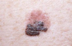Figure 4: Melanoma—close-up of color changes Figure 4: Melanoma—close-up of color changes