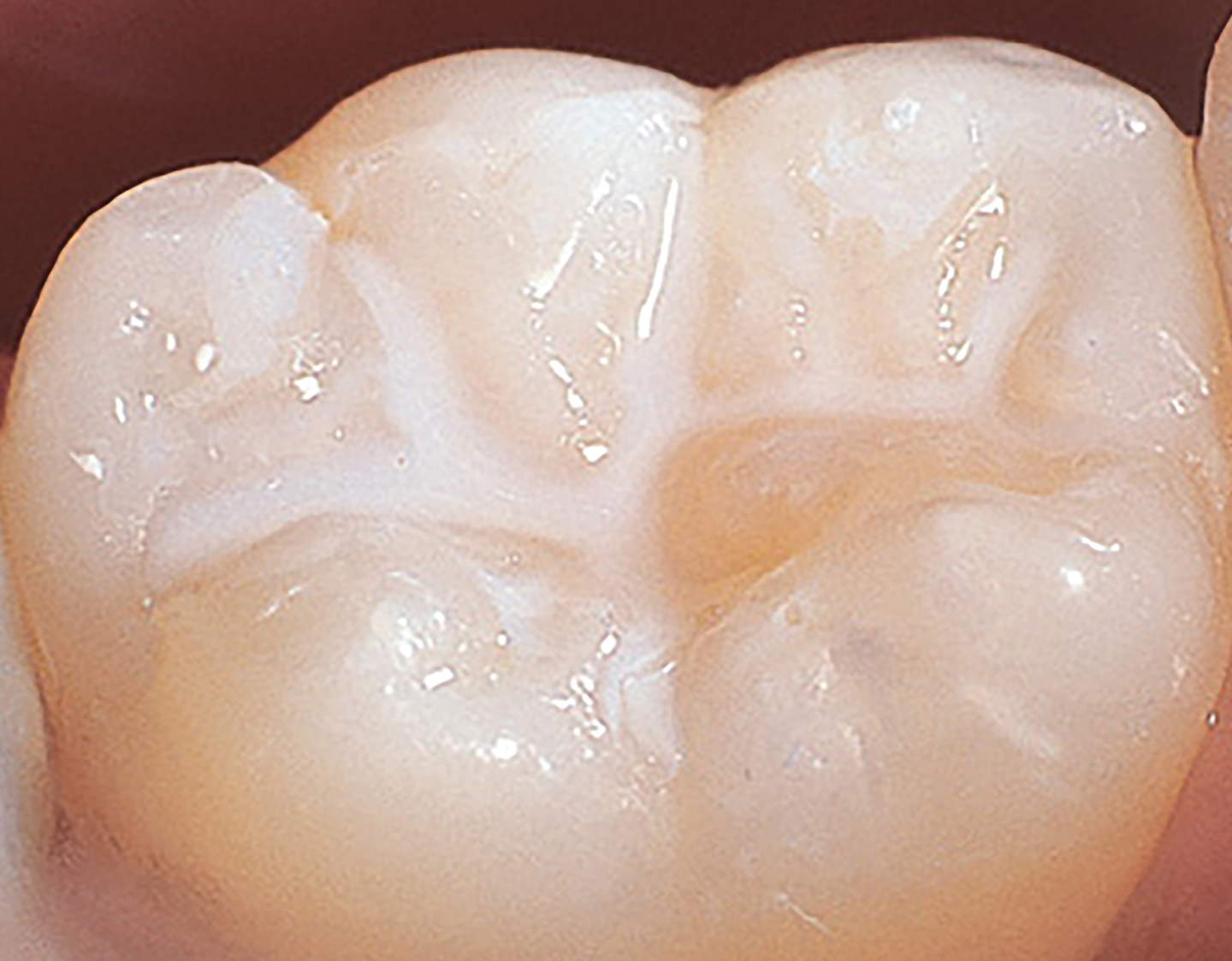 Don't underestimate the power of dental sealants | Dental Economics Don't underestimate the power of dental sealants | Dental Economics