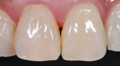 Frontline teeth top