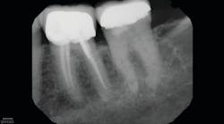 Figure 1: Preoperative projection radiograph emailed from restorative dentist for retreatment of tooth no. 19 is unremarkable for periapical findings. Tooth no. 18 is also unremarkable for periapical findings.