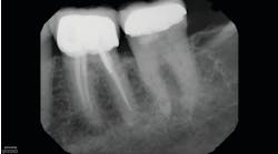 Figure 1: Preoperative projection radiograph emailed from restorative dentist for retreatment of tooth no. 19 is unremarkable for periapical findings. Tooth no. 18 is also unremarkable for periapical findings.
