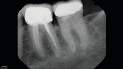 Figure 1: Preoperative projection radiograph emailed from restorative dentist for retreatment of tooth no. 19 is unremarkable for periapical findings. Tooth no. 18 is also unremarkable for periapical findings. Figure 1: Preoperative projection radiograph emailed from restorative dentist for retreatment of tooth no. 19 is unremarkable for periapical findings. Tooth no. 18 is also unremarkable for periapical findings.