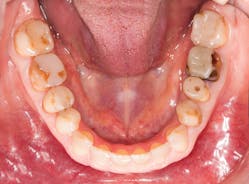 Figure 1: Occlusal view showing extensive and deficient restorations