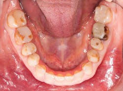 Figure 1: Occlusal view showing extensive and deficient restorations Figure 1: Occlusal view showing extensive and deficient restorations