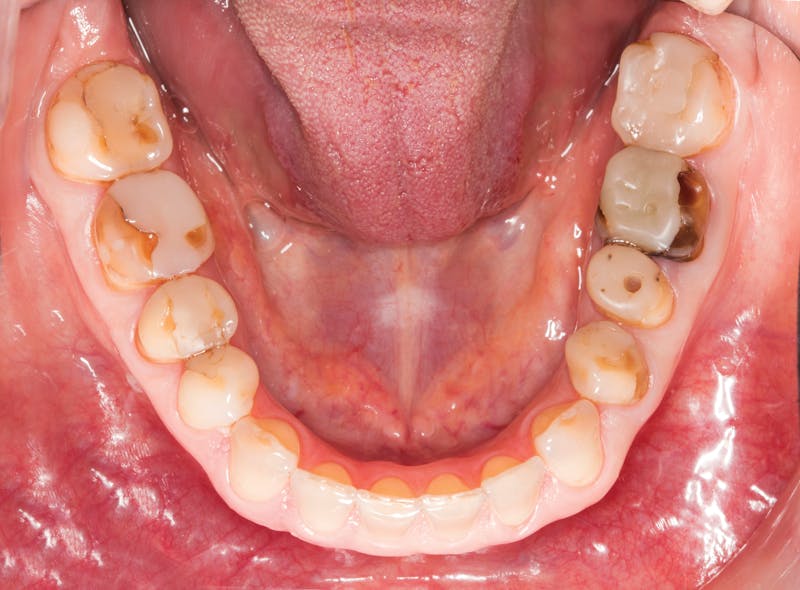 Figure 1: Occlusal view showing extensive and deficient restorations