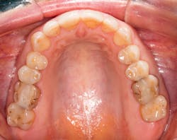 Figure 2: Occlusal view showing extensive and deficient restorations Figure 2: Occlusal view showing extensive and deficient restorations