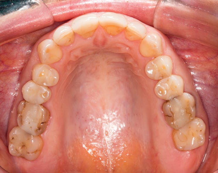 Figure 2: Occlusal view showing extensive and deficient restorations