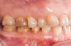 Figure 3: Lateral pre-op view showing discolored teeth Figure 3: Lateral pre-op view showing discolored teeth