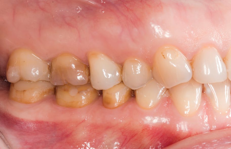 Figure 3: Lateral pre-op view showing discolored teeth