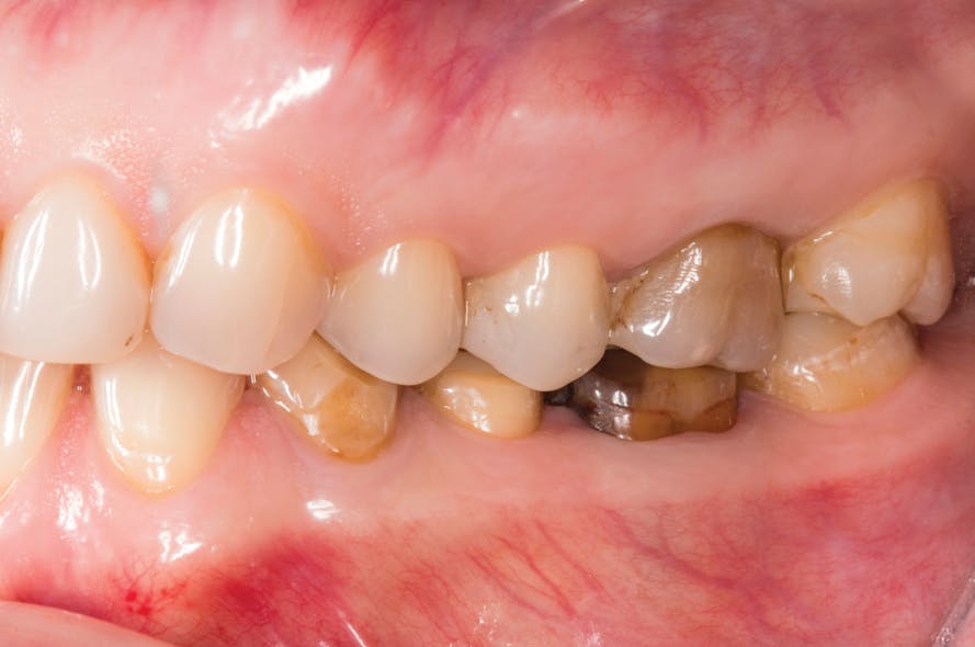 Figure 4: Lateral pre-op view showing discolored teeth