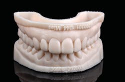 Figure 5: 3-D printed models of diagnostic wax-up Figure 5: 3-D printed models of diagnostic wax-up