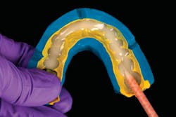Figure 6: LuxaCrown injected into a PVS matrix Figure 6: LuxaCrown injected into a PVS matrix